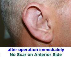 plastic-surgery-prominent-ear 